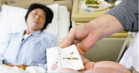 通過手術(shù)取出的針?！　∩虉笥浾?
